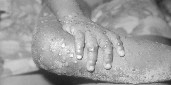 Впервые: израильтянин заразился обезьяньей оспой внутри страны0